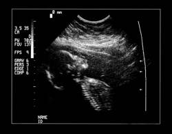 Ultrasound of Fetus